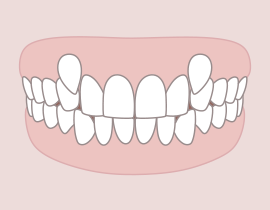 Túl korai vagy túl késői fogváltás