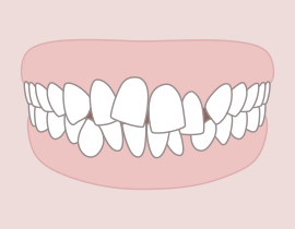 Rágás, harapási nehézségek