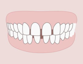 Fogtorlódás vagy túl nagy rések