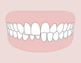 Rendszeres belső szájharapás