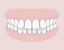 Nem megfelelően érintkező fogak