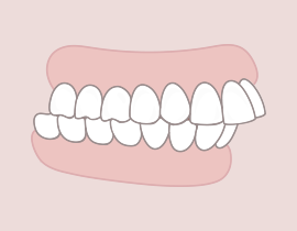 Aránytalan állkapocs vagy előreálló fogak